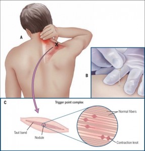 dry needling